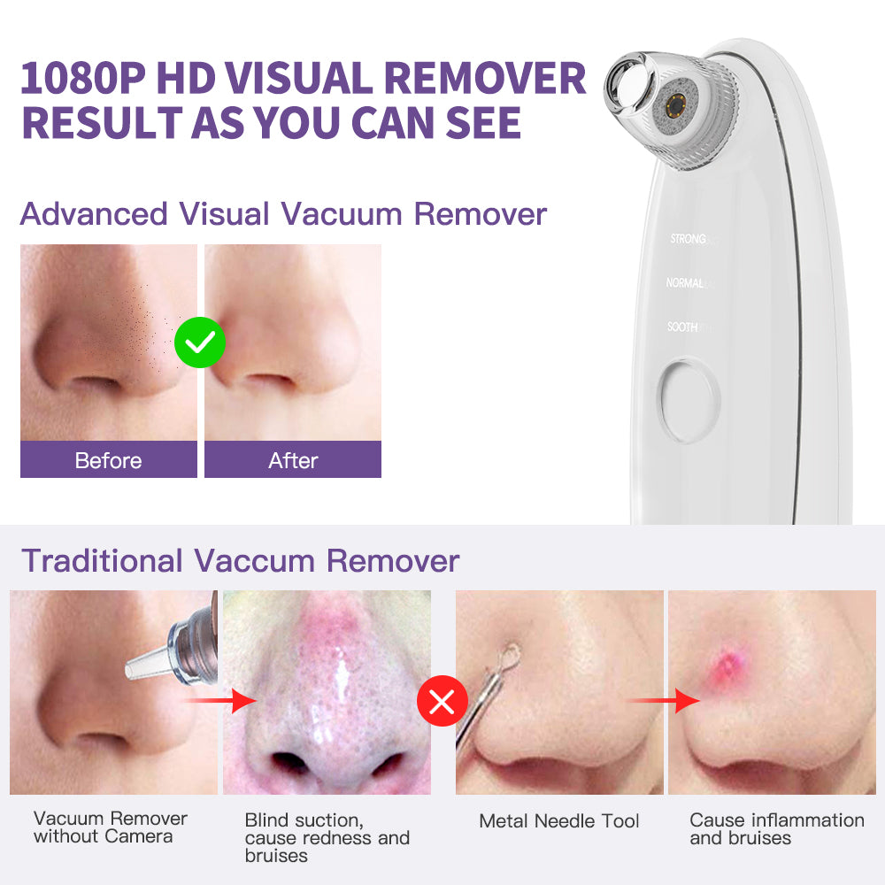 Blackhead Remover